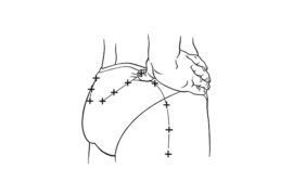 Dry needling bij bekkenpijn en posturale disfuncties 10